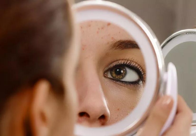 Tips To Help Get Rid of Pimples Fast