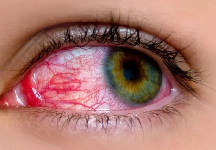 8 Common Myths About Pink Eye
