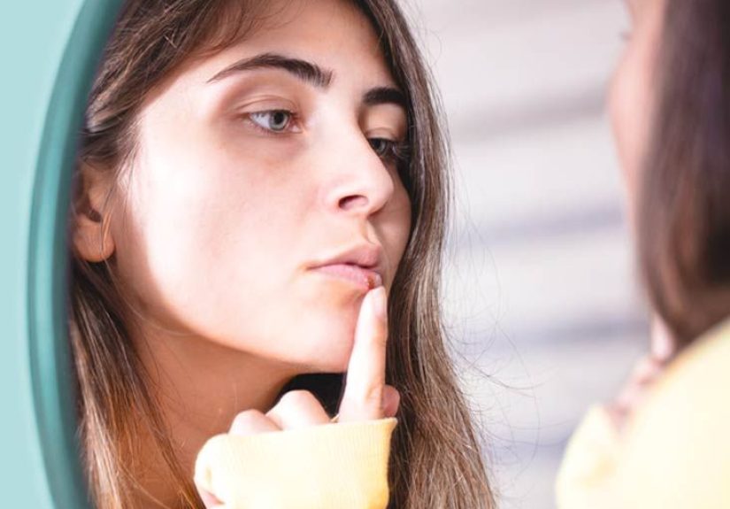 Cold Sores 101: 7-Question Quiz