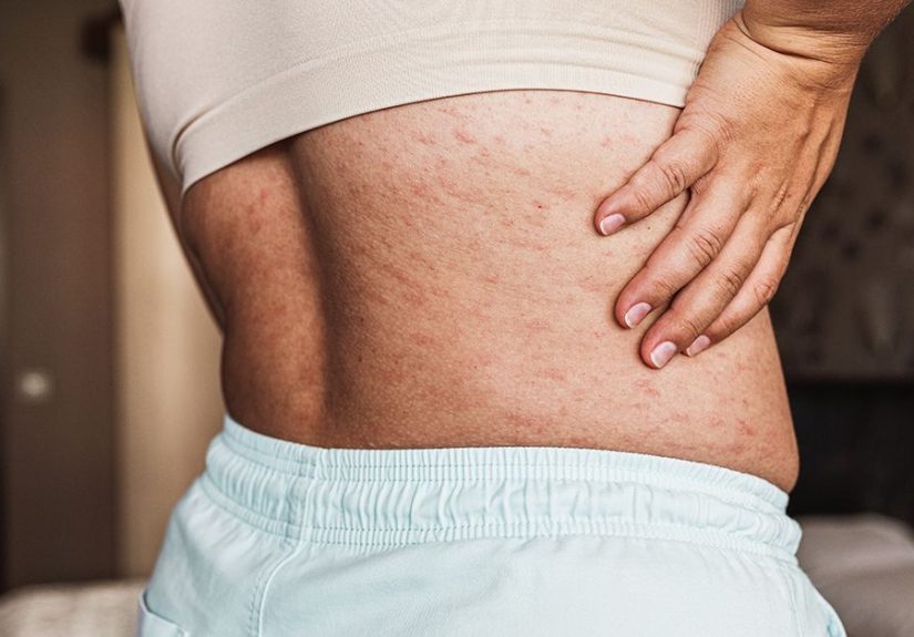 Eczema Progression: What It Looks Like