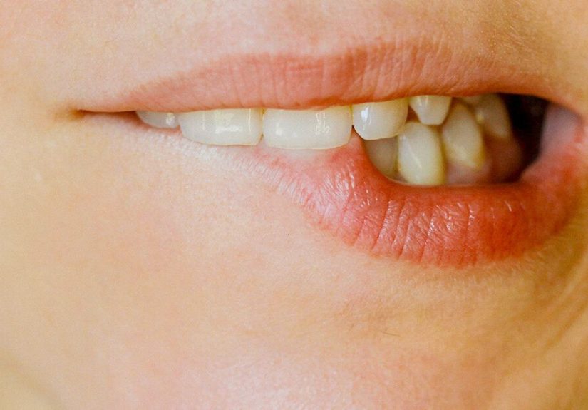 Popping a Cold Sore: What Happens and What to Do Instead