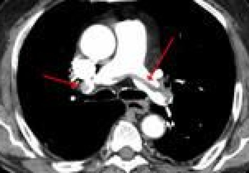 Pulmonary Embolism (Blood Clot in Lung): Symptoms and More