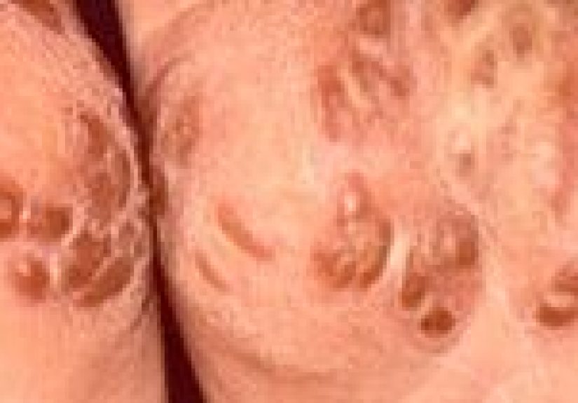 Reactive Arthritis: Causes, Symptoms, and Diagnosis