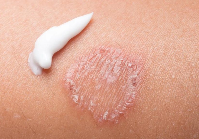 Tips for Getting Rid of Ringworm