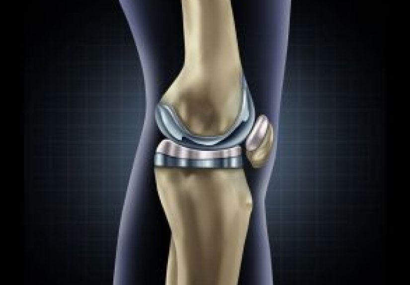 Total Knee Replacement - Harvard Health