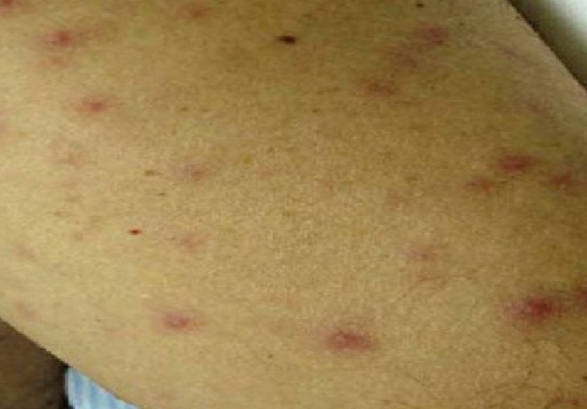 Typhus: Causes, Symptoms, and Diagnosis