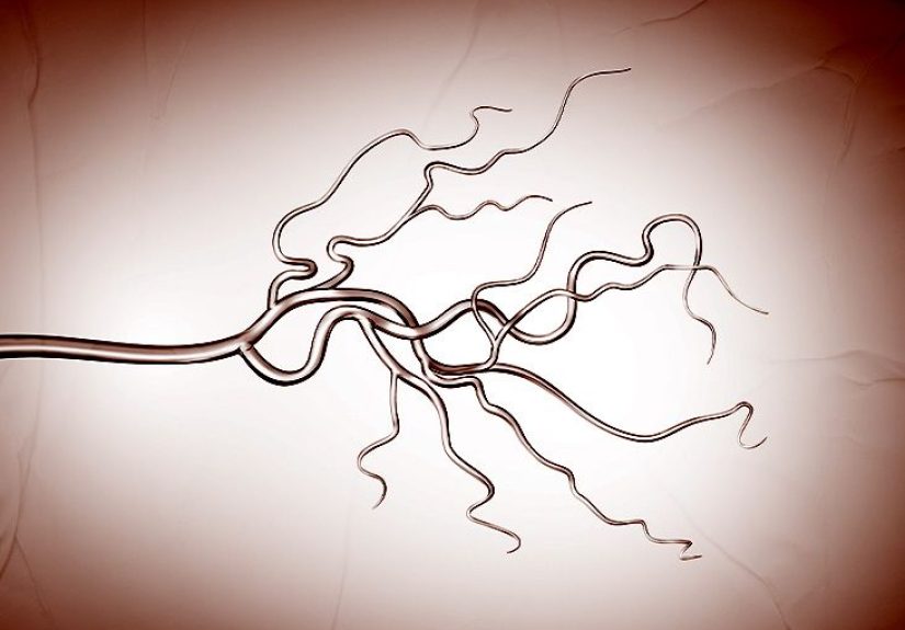 Vasculitis: Treatment, Symptoms, Causes, and Types