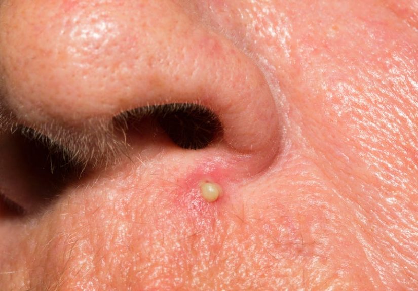 Your Face’s “Triangle of Death” Can Turn a Popped Pimple Into Paralysis
