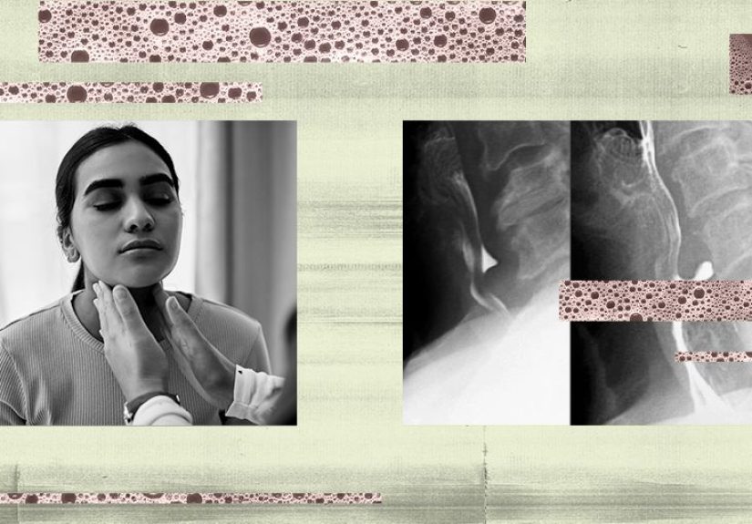 Zenker's diverticulum: Symptoms, causes, and surgery