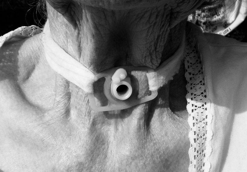 Aspiration with tracheostomy: What are the risks?