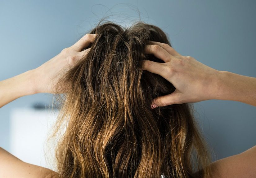Best Home Remedies for Scalp Psoriasis Itch and Irritation