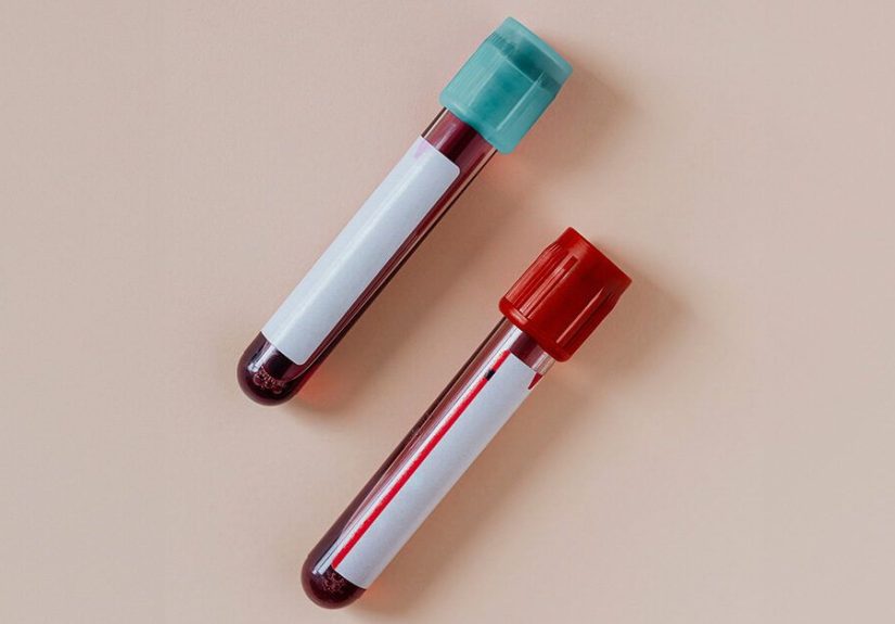 Blood Test for Dementia: What’s Available?