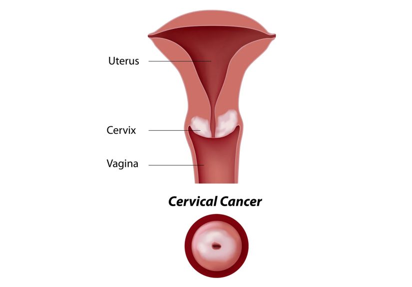 Cervical Cancer: Symptoms, Causes, and Treatment