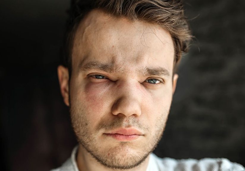 How Hereditary Angioedema Causes Pain