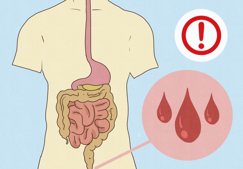 How to Perform an Enema at Home: Expert Tips