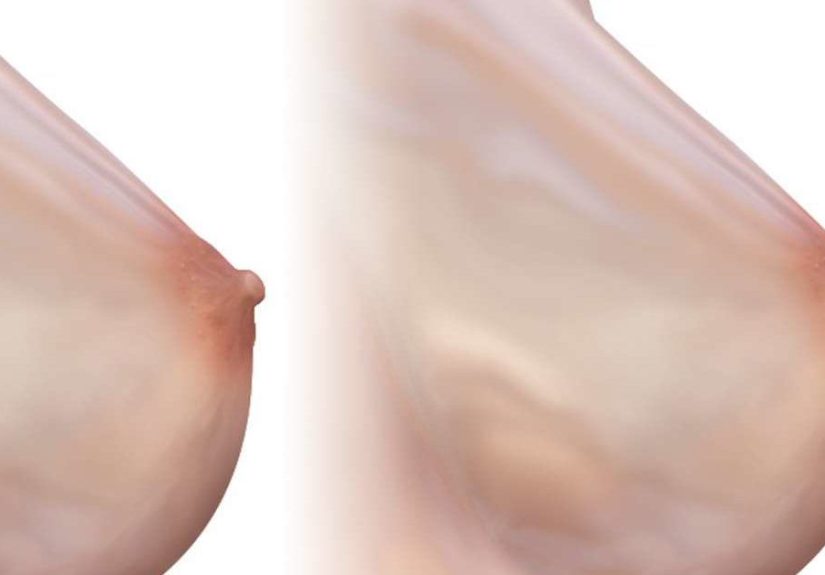 Inverted nipple: Treatment, causes, and pictures