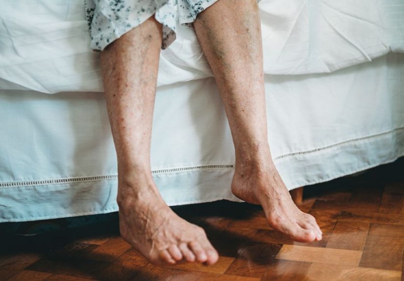 Polycythemia Leg Pain: Treatment and Prevention