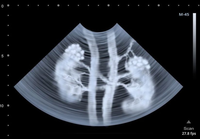 Renal Scan: Purpose, Procedure, and Results