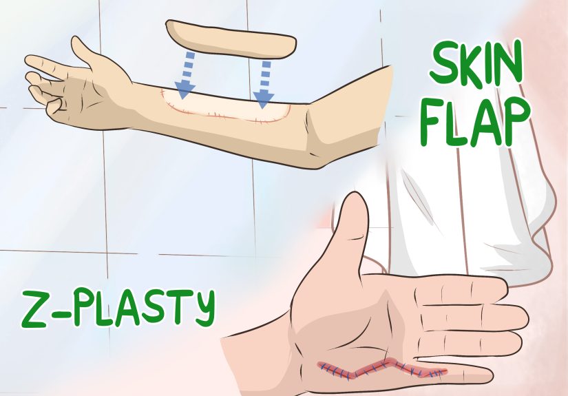 3 Ways to Get Rid of Burn Scars