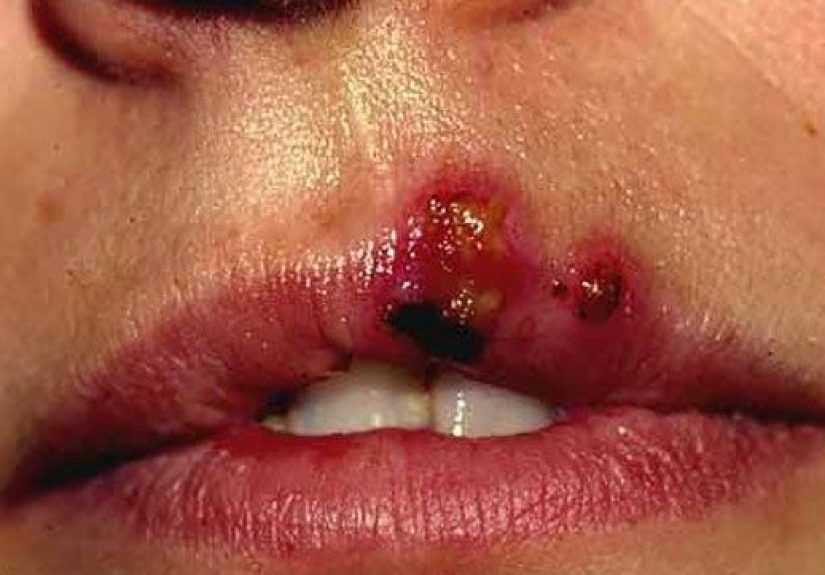 Ampollas: Imágenes, causas, tratamiento y prevención