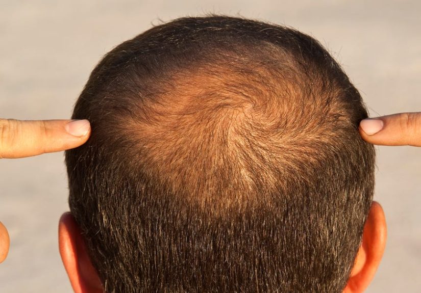 Experimental Drug PP405 May Wake Up Dormant Follicles to Regrow Hair