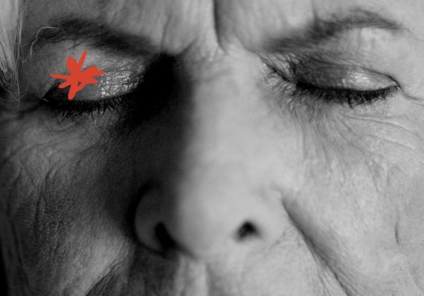 Eyelid dermatitis: Symptoms, treatments, causes, and more