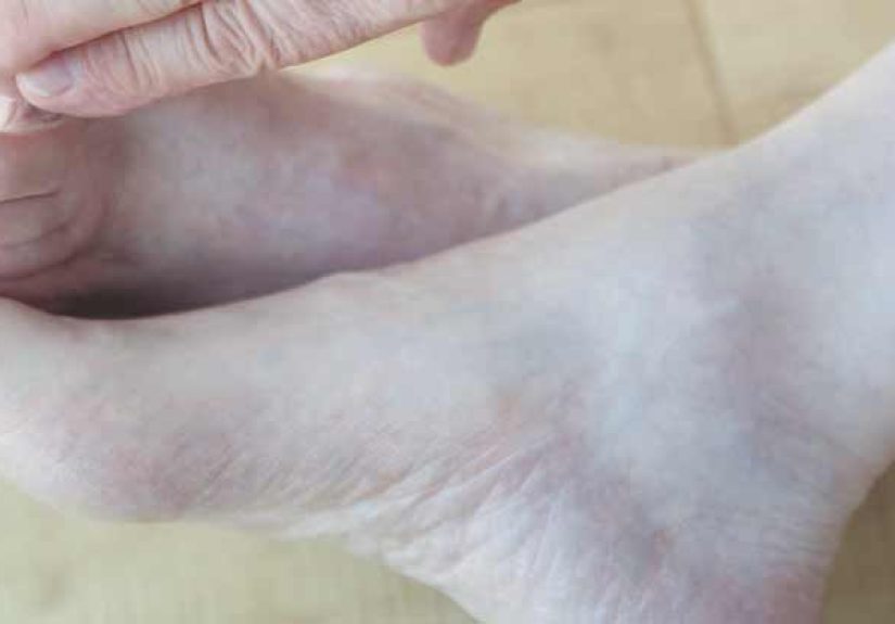 Gangrene and Diabetes: Understanding the Link