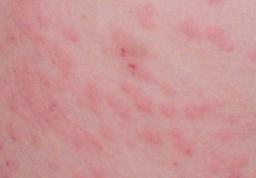 Histoplasmosis: Cause, Types & Complications