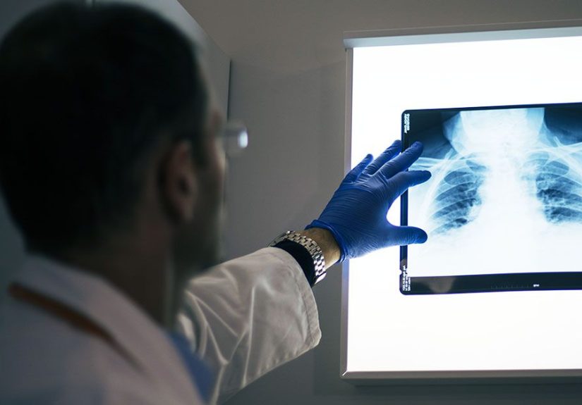 How Long Can You Live with Stage 4 NSCLC?
