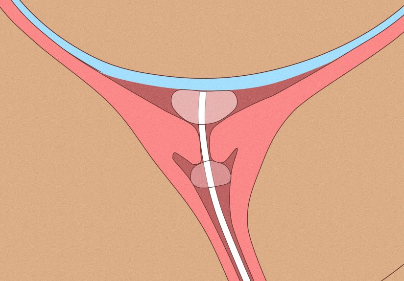 How to Dilate Faster: At-Home & Medical Methods