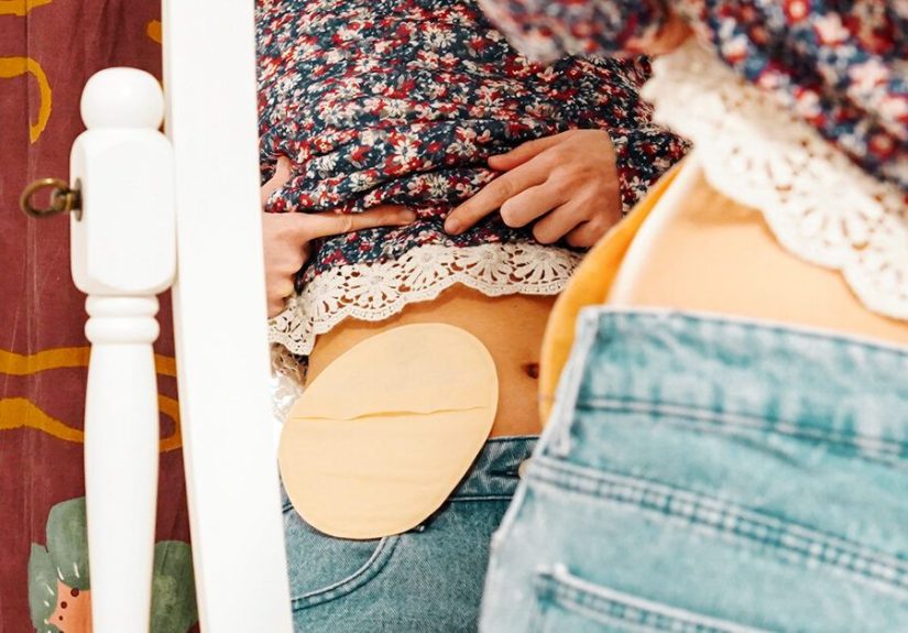 Leaking Colostomy Bag: Signs, Causes, and What to Do