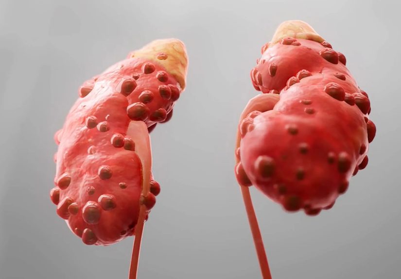 Symptoms, Causes, and Treatments of Autosomal Dominant Polycystic Kidney Disease