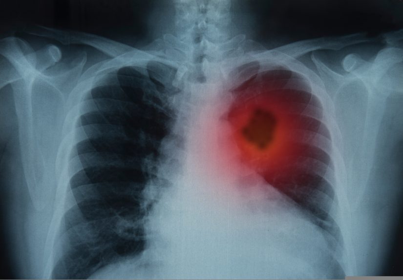 This Lung Cancer Awareness Month Is Like No Other