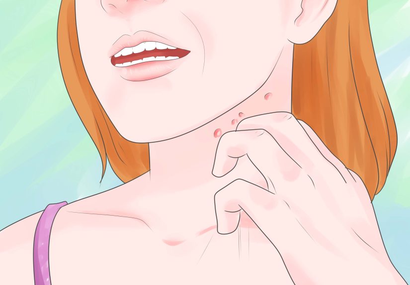 3 Ways to Treat Folliculitis