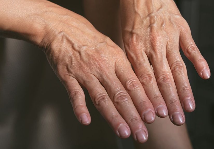 Bulging Hand Veins: Causes and When to Seek Treatment
