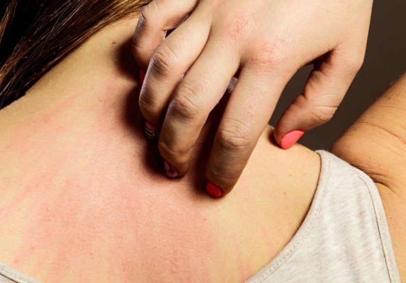 Common Allergic Conditions Linked to Mental Health