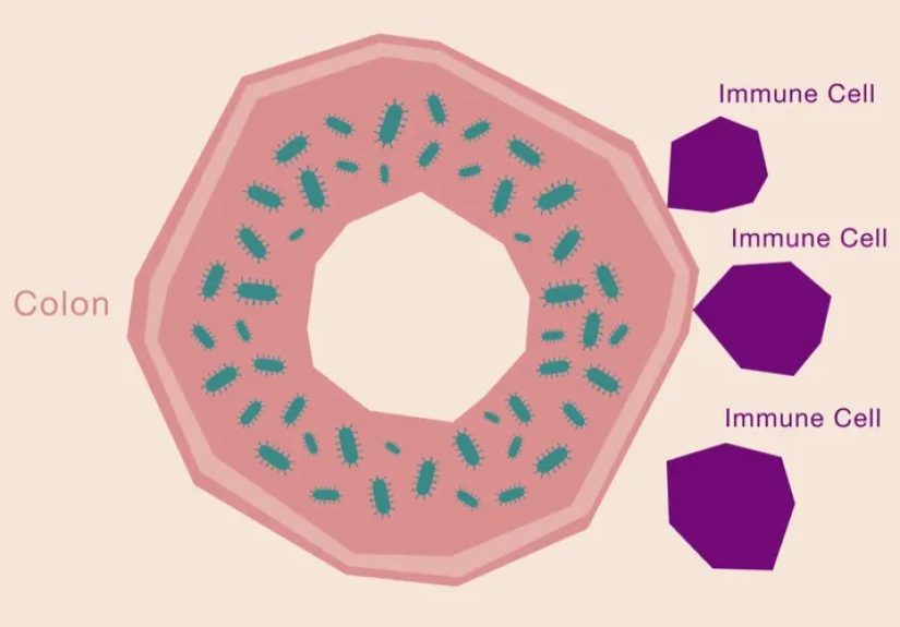 Ulcerative Colitis: Inside a Colon