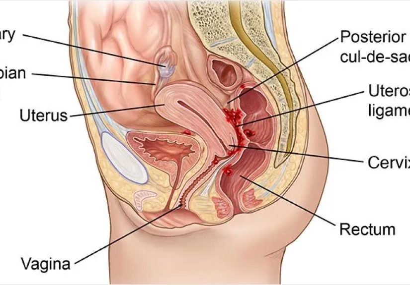 Endometriosis and Painful Sex: How to Cope