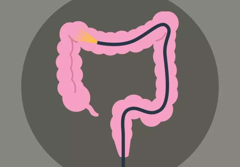 How Safe Are Colonoscopies?