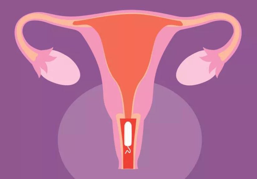 Stuck Tampon? Here’s How To Remove It