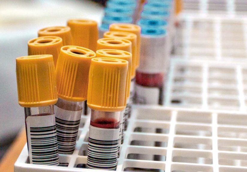 Aspartate Aminotransferase (AST) Test (SGOT) Purpose