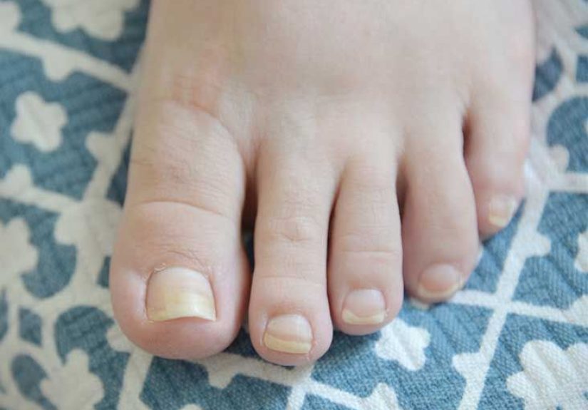Splinter Hemorrhages: Symptoms, Causes, and Treatments